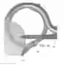 Fig. 61 - Circular bone tunneling device employing a stabilizing element