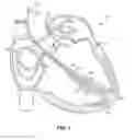 Fig. 02 - Devices and Methods for Improving Transcatheter Aortic Valve Implantation
