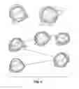 Fig. 05 - Devices and Methods for Improving Transcatheter Aortic Valve Implantation