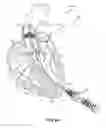 Fig. 06 - Devices and Methods for Improving Transcatheter Aortic Valve Implantation