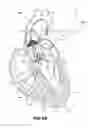 Fig. 07 - Devices and Methods for Improving Transcatheter Aortic Valve Implantation