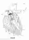 Fig. 08 - Devices and Methods for Improving Transcatheter Aortic Valve Implantation