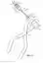 Fig. 14 - Devices and Methods for Improving Transcatheter Aortic Valve Implantation