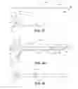 Fig. 08 - Hydraulic displacement and removal of thrombus clots, and catheters for performing hydraulic displacement
