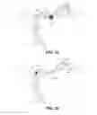 Fig. 12 - Hydraulic displacement and removal of thrombus clots, and catheters for performing hydraulic displacement