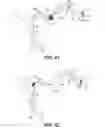 Fig. 15 - Hydraulic displacement and removal of thrombus clots, and catheters for performing hydraulic displacement