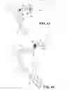 Fig. 16 - Hydraulic displacement and removal of thrombus clots, and catheters for performing hydraulic displacement