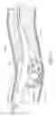 Fig. 12 - Thrombectomy catheter