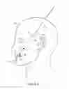 Fig. 12 - Lifting surgical instrument having branch point