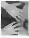 Fig. 04 - Fluorouracil glycolate compound for the treatment of warts, molluscum contagiosum