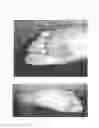 Fig. 05 - Fluorouracil glycolate compound for the treatment of warts, molluscum contagiosum