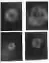 Fig. 07 - Fluorouracil glycolate compound for the treatment of warts, molluscum contagiosum