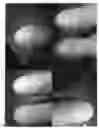 Fig. 15 - Fluorouracil glycolate compound for the treatment of warts, molluscum contagiosum