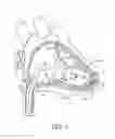 Fig. 02 - Electrode fixation in interventional medical systems