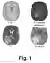 Fig. 02 - Automatic 3D brain tumor segmentation and classification