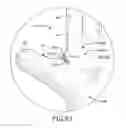 Fig. 19 - Protective device for use with a glove