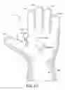 Fig. 14 - Protective device for use with a glove