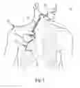 Fig. 02 - Method and apparatus for sensing respiratory pressure in an implantable stimulation system