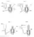 Fig. 03 - Device for treatment of aneurysm