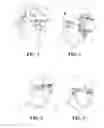 Fig. 03 - Selecting triggers of an allergic reaction based on nasal temperatures