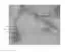 Fig. 03 - SURGICAL RETRACTOR