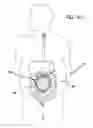Fig. 04 - Surgical access device comprising internal retractor
