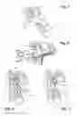 Fig. 03 - Glenoid cavity bone preparation set for setting a shoulder prosthesis, and method for implanting a shoulder prosthesis