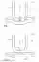 Fig. 02 - Surgical instrument having a surface texture