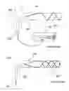 Fig. 10 - Methods and apparatus for performing a non-continuous circumferential treatment of a body lumen