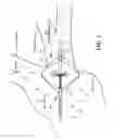 Fig. 04 - Vein occlusion assessment using temperature