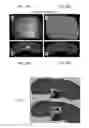 Fig. 11 - Biomechanical model assisted image guided surgery system and method