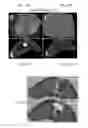 Fig. 12 - Biomechanical model assisted image guided surgery system and method