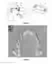 Fig. 02 - Method for determining a mapping of the contacts and/or distances between the maxillary and mandibular arches of a patient