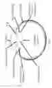 Fig. 03 - Accommodative intraocular lens that ejects post capsular opacification and self-centers