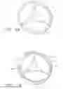 Fig. 02 - Systems, apparatus and methods for sealing perivalvular leaks