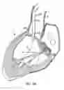 Fig. 08 - Everting heart valve