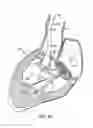 Fig. 09 - Everting heart valve