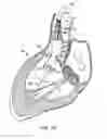 Fig. 10 - Everting heart valve