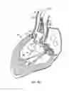 Fig. 11 - Everting heart valve