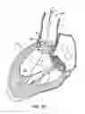 Fig. 13 - Everting heart valve