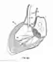 Fig. 14 - Everting heart valve