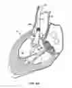Fig. 15 - Everting heart valve