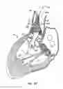 Fig. 16 - Everting heart valve