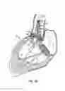 Fig. 17 - Everting heart valve