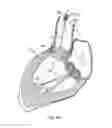 Fig. 19 - Everting heart valve