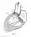 Fig. 20 - Everting heart valve