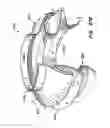Fig. 47 - Everting heart valve