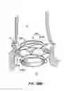 Fig. 49 - Everting heart valve