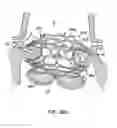 Fig. 50 - Everting heart valve