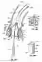 Fig. 53 - Everting heart valve
